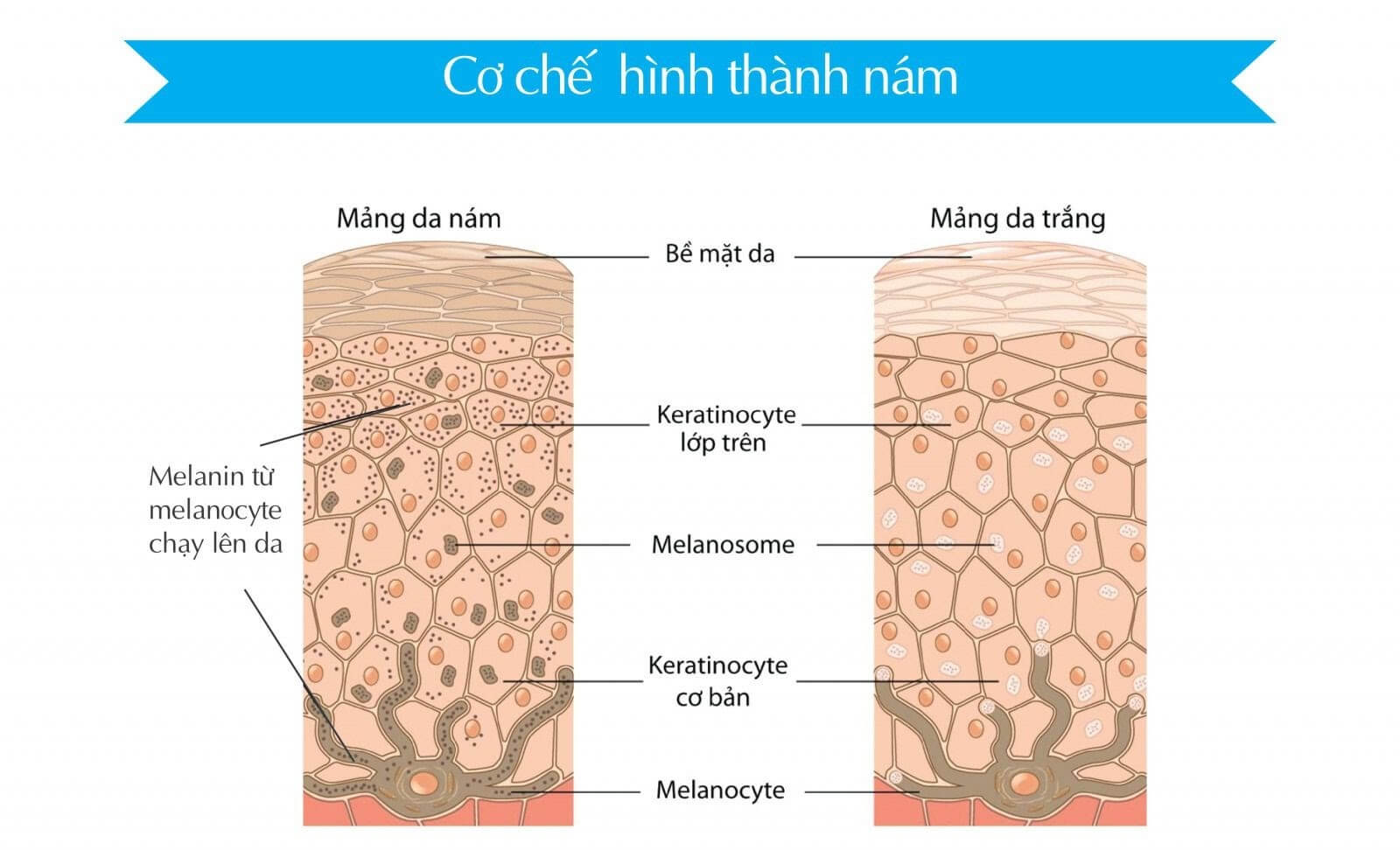 nguyen_nhan_hinh_thanh_dom_da